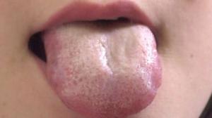 舌の表面が白いのは、胃腸に炎症が起きているサイン